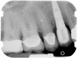 An x-ray photo of dental implants in Colorado Springs, CO